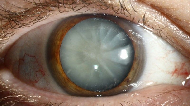 Cataract Awareness