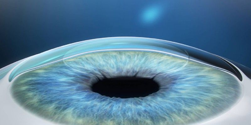 Cornea Surgery