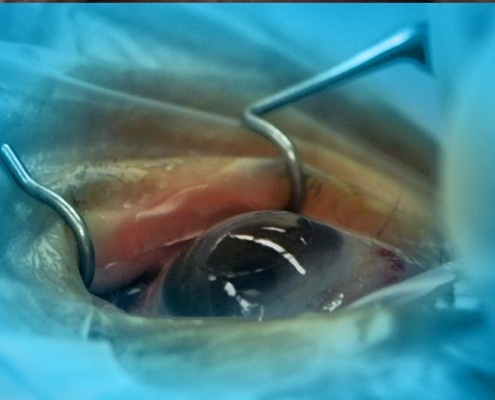 Candidate for Cornea Surgery