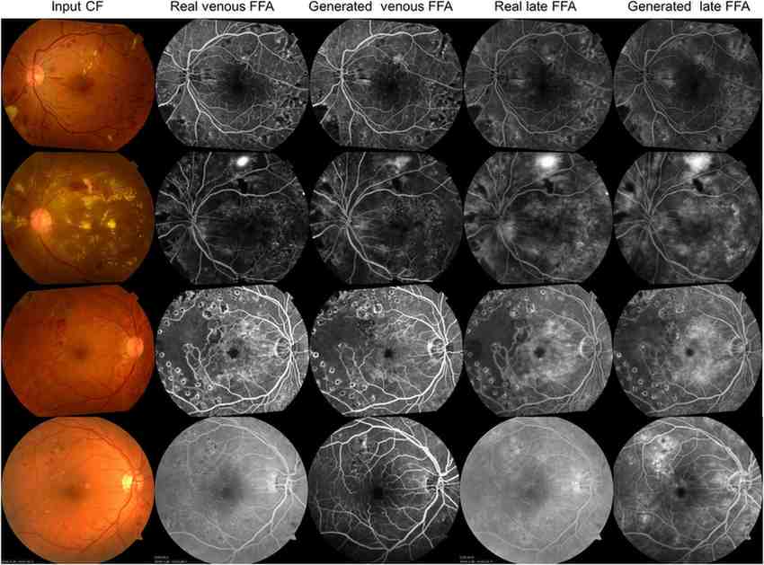 Diagnosis of Diabetic Eye Problems