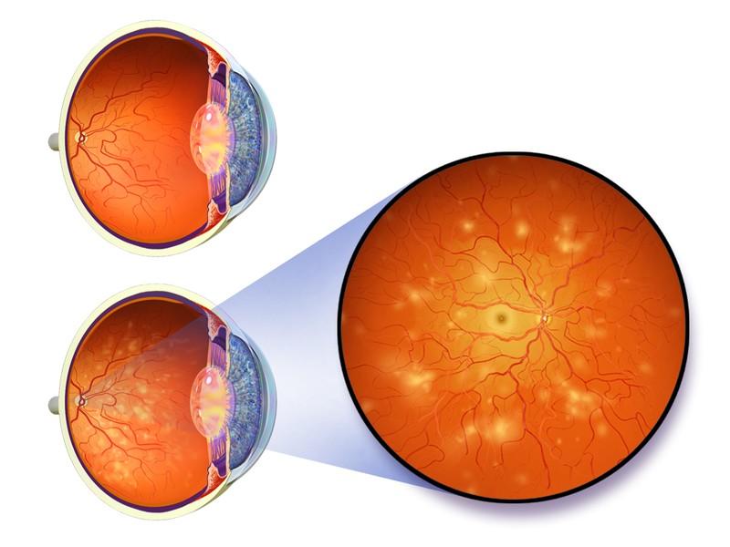 Risks of Ignoring Diabetic Eye Care