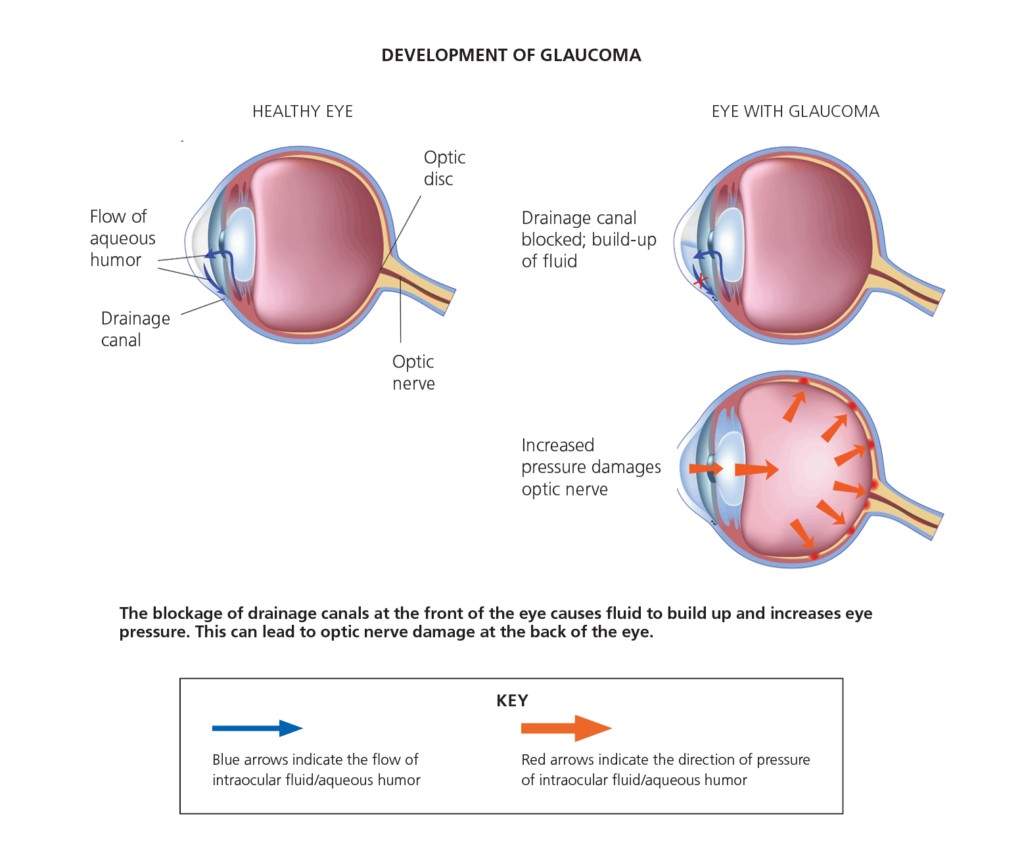 Risks of Glaucoma Surgery
