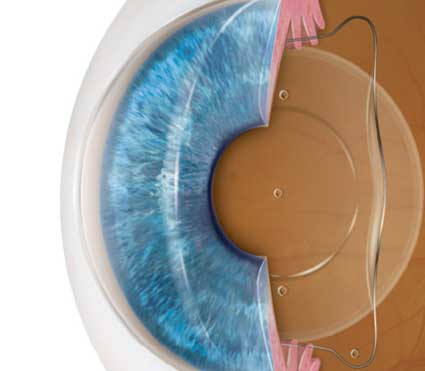 What is ICL Surgery
