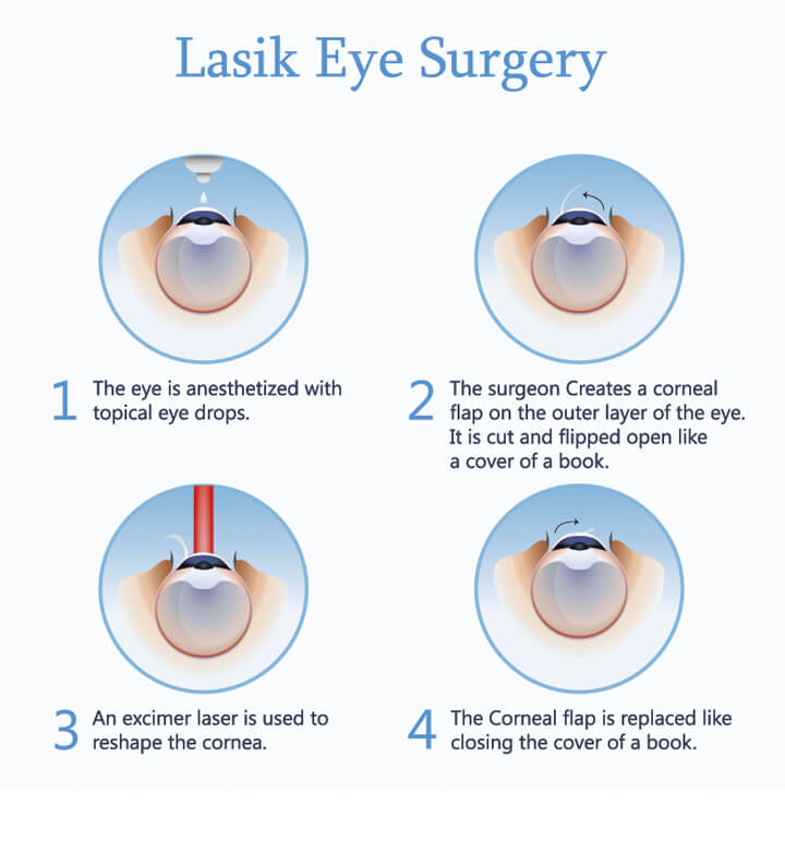 What is LASIK Surgery
