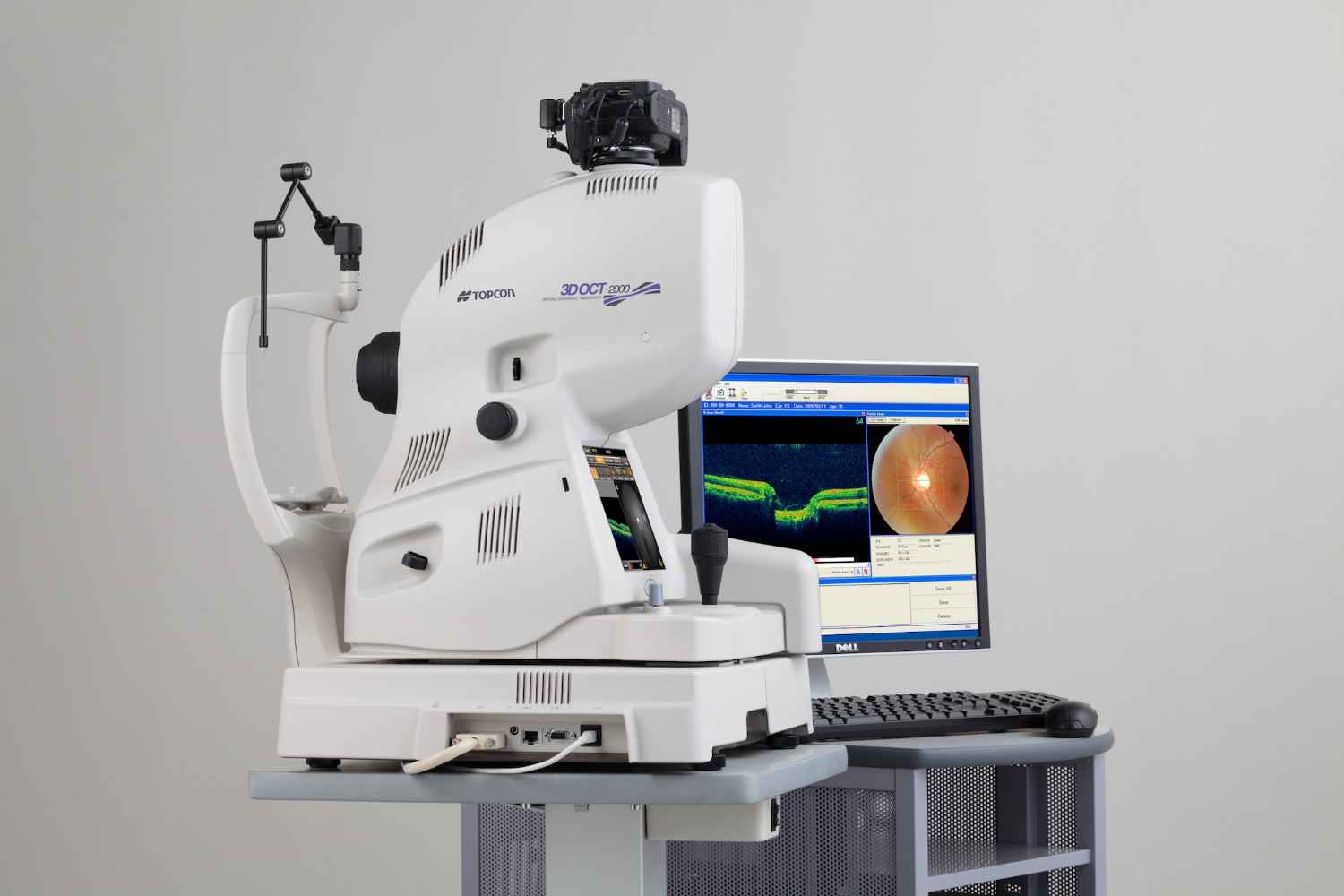 OCT Scan and YAG Laser Procedures