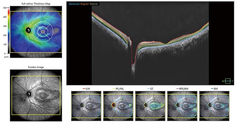 Who Needs OCT Scan or YAG Laser