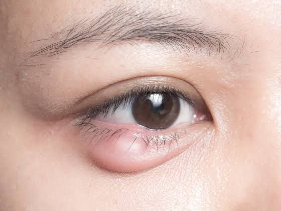 Causes of Oculoplastic Disorders