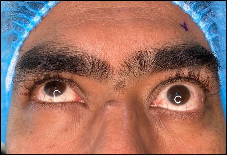 Preventing Oculoplasty Issues