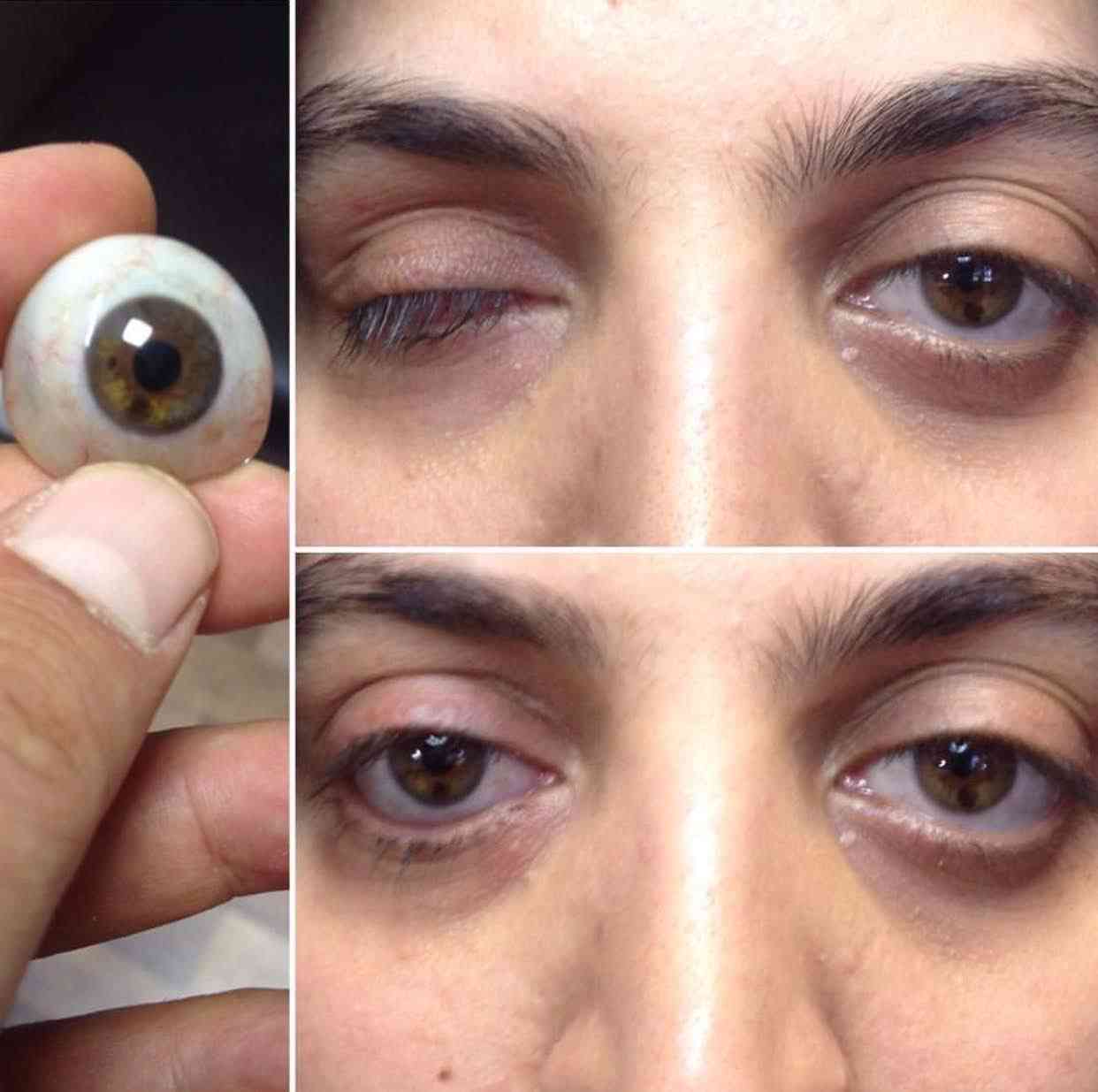 Symptoms of Oculoplasty Conditions