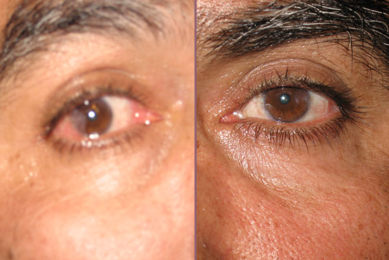 Candidate for Pterygium Surgery