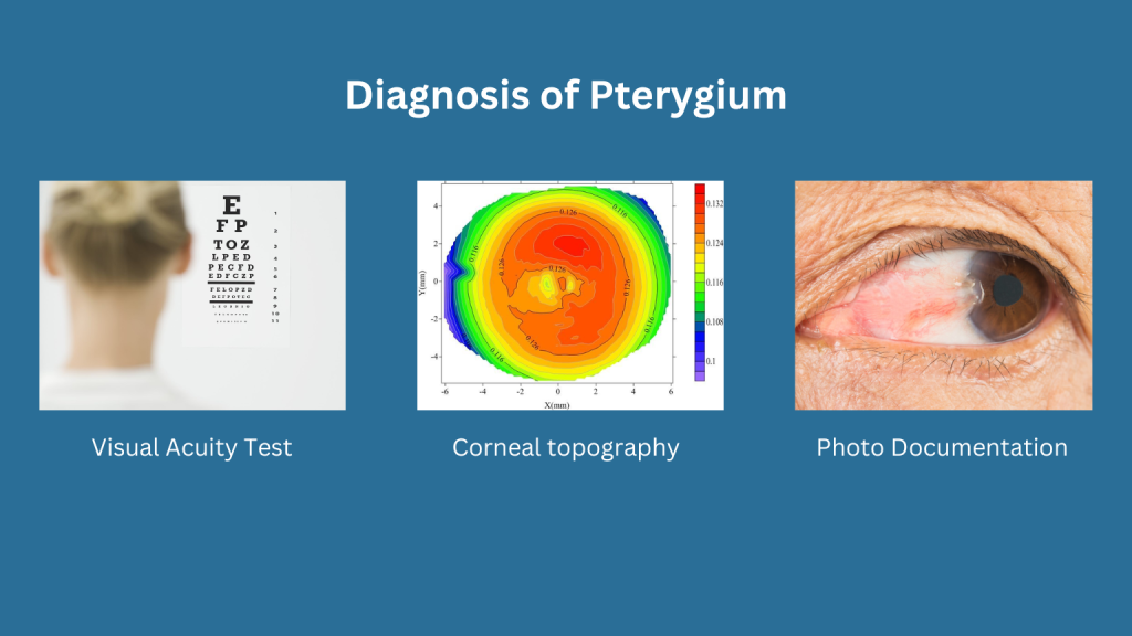 Diagnosis of Pterygium