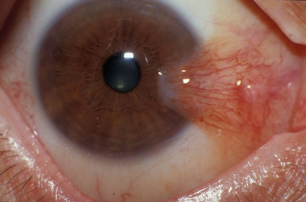 Preventing Pterygium