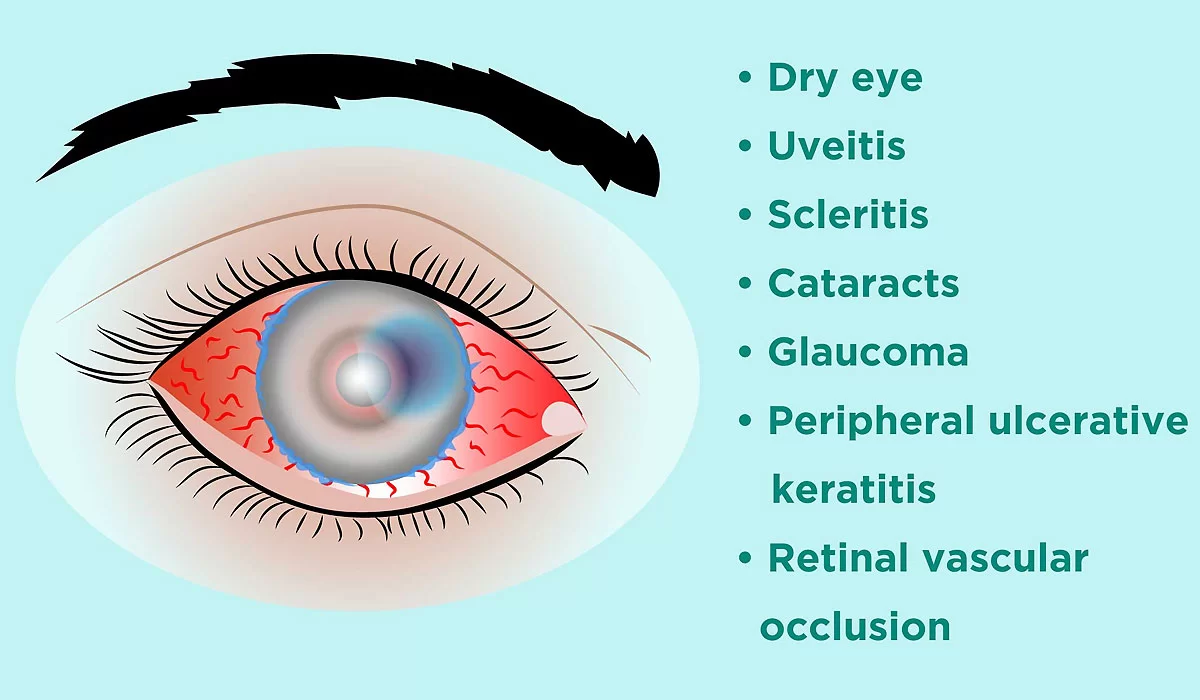 Causes of Age-Related Eye Problems
