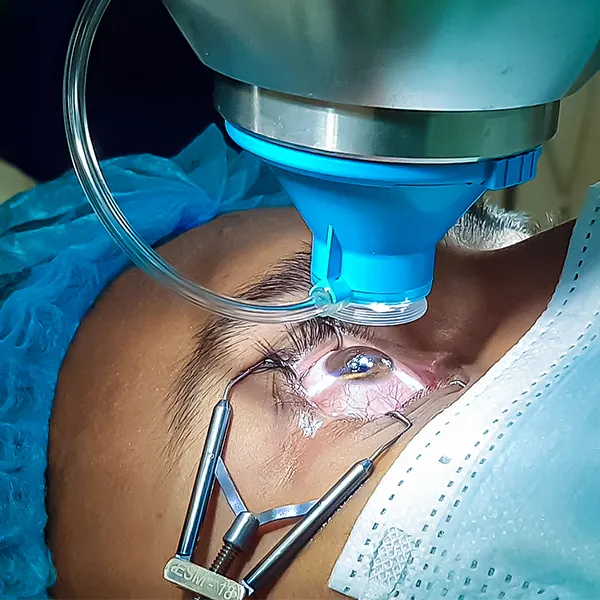 LASIK Surgery