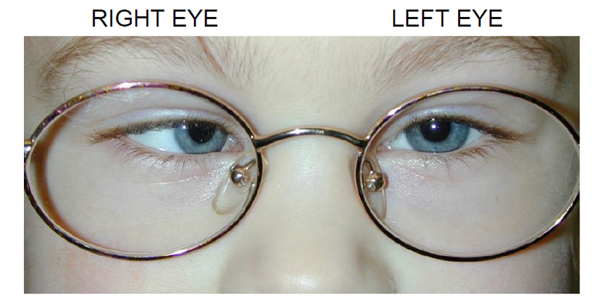 Diagnosis of Squint