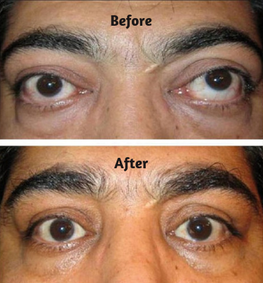 Squint Surgery Recovery
