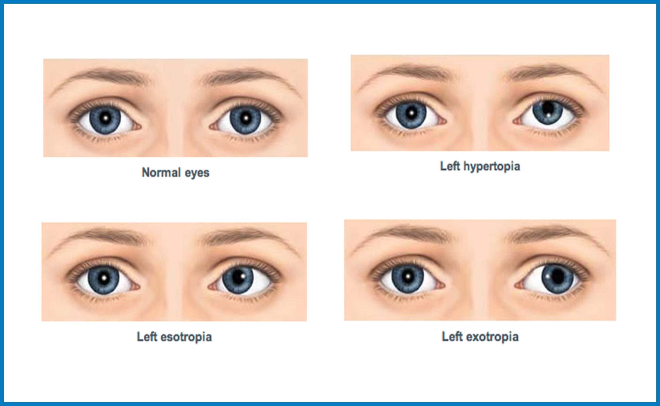 Types of Squint
